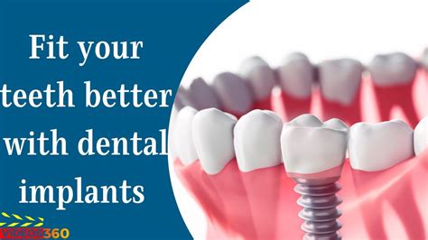 Dental Implants At Kellerman Dental Explained By Dr Kevin Kellerman