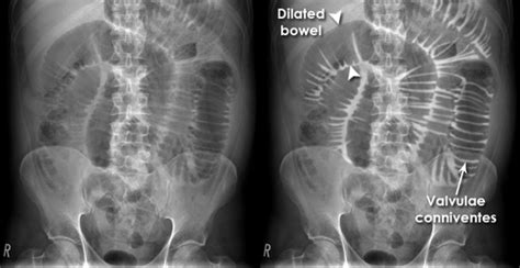 Small And Large Bowel Obstruction Flashcards Quizlet