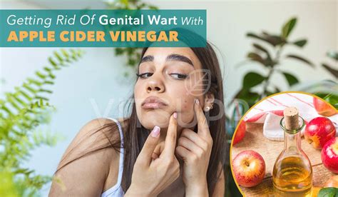 Apple Cider Vinegar For Warts Removal Vitsupp