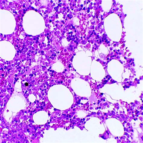 Bone Marrow Biopsy Shows Normal Global Cellularity Granulocytic