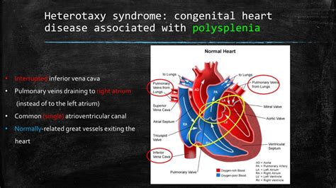 PPT - Congenital heart defects and heterotaxy syndrome PowerPoint Presentation - ID:2282637