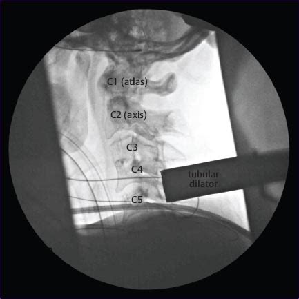 Minimally Invasive Posterior Cervical Foraminotomy Neupsy Key