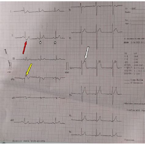 12 Lead Ecg Showing Sinus Rhythm With Hr Of 72 Bpm With Resolution Of