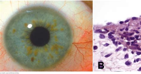 neuropathology blog: Lisch nodules in a patient with NF-1