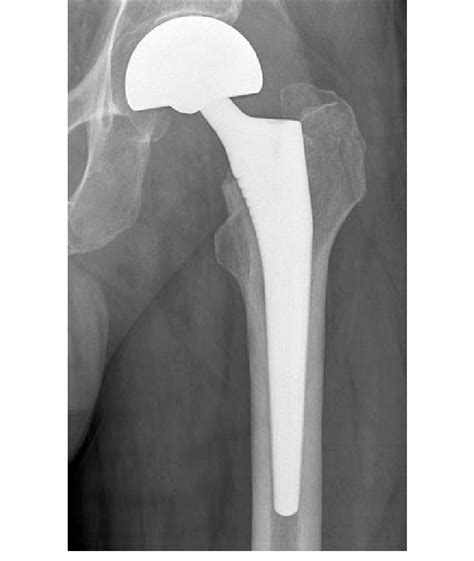 A Radiograph Shows The Corail 1 Uncemented Bipolar Implant Download Scientific Diagram