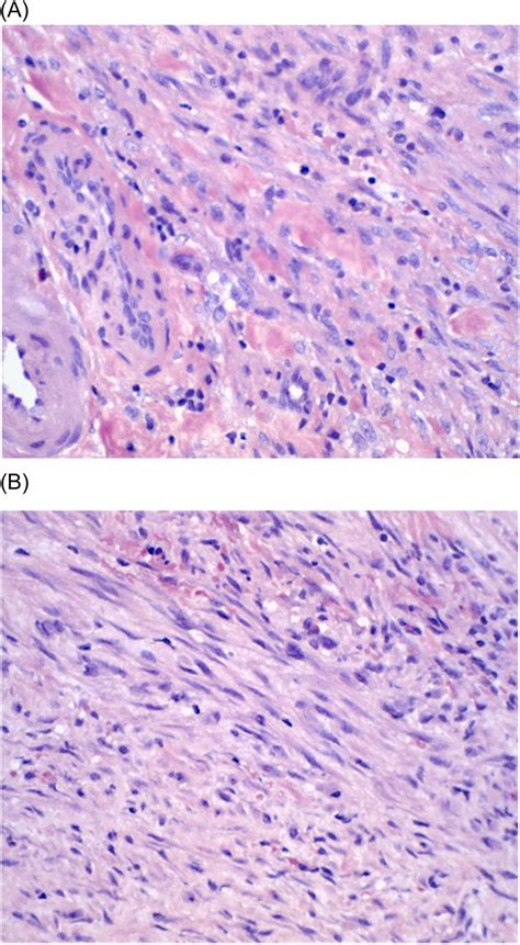 Infarction Of Paratesticular Inflammatory Myofibroblastic Tumor