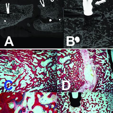 A Generated Ct Scan Months After Implantation Of The Htgf