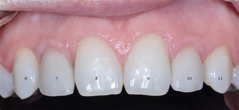 Single Implant Case Puget Sound Periodontics Thomas Kang Dds