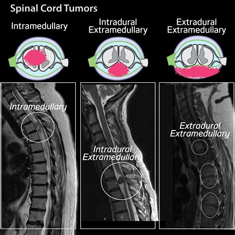 Clinical Pathology Glossary: Spinal Cord Tumors | ditki medical ...