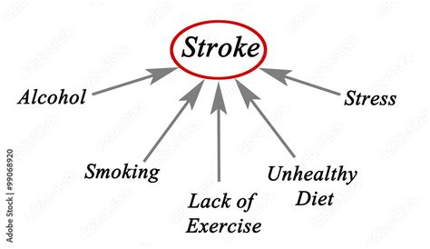 Causes of Stroke Stock Illustration | Adobe Stock