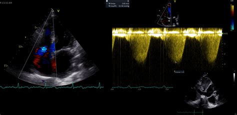 Echocardiographic Pulmonary Artery Systolic Pressure PAPsystolic