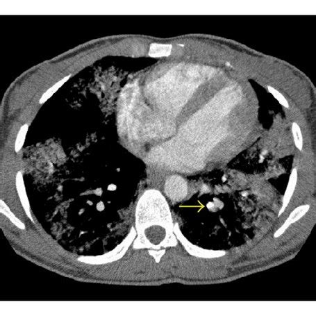 Volumetric Computed Tomography Acquisition Of The Chest From The