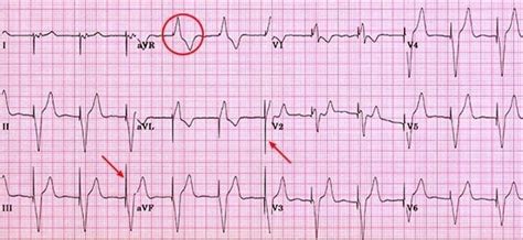 Single Chamber Pacemaker