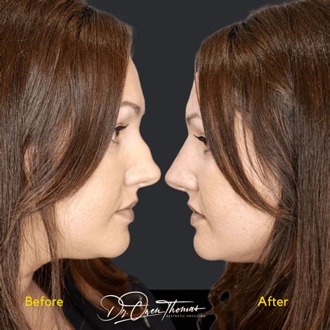 Non Surgical Rhinoplasty London Infinity Aesthetics