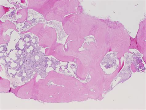 Histopathological section of middle ear osteoma showing fragments of ...