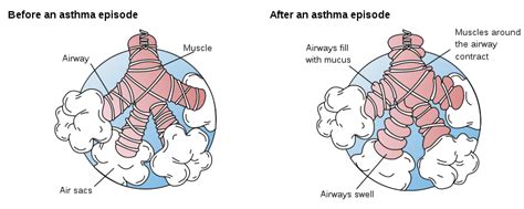 Bronchospasm pathophysiology - wikidoc