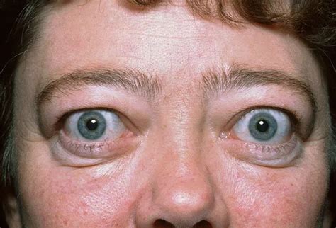 Picture Of Graves Disease Picture Image On Rxlist