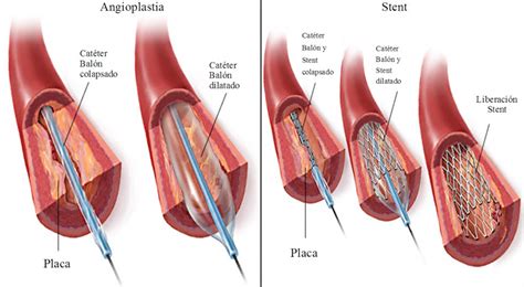 Cateterismo cardiaco - Cardiología Hospital Universitario Puerta de Hierro Majadahonda