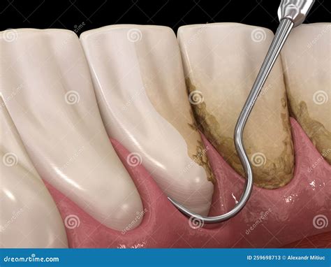 Oral Hygiene Scaling And Root Planing Conventional Periodontal Therapy Medically Accurate 3d