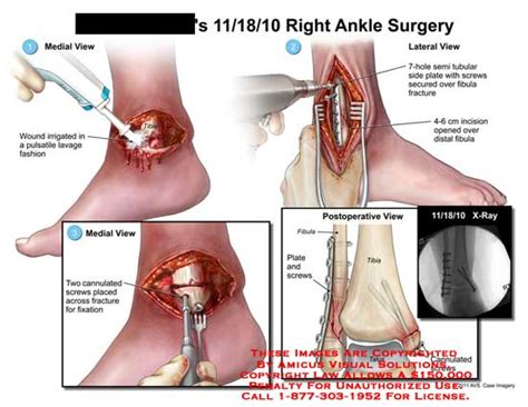 Amicus Illustration Of Amicus Surgery Ankle Irrigated Pulsatile Lavage