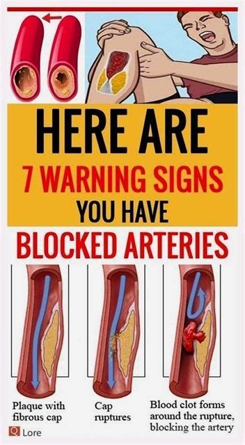 Here Are Warning Signs You Have Blocked Arteries Arteries Warning