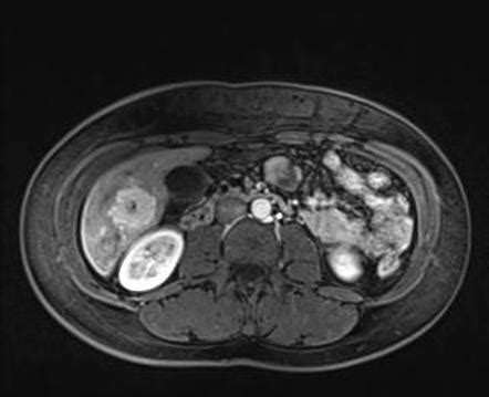 Focal Nodular Hyperplasia Radiology