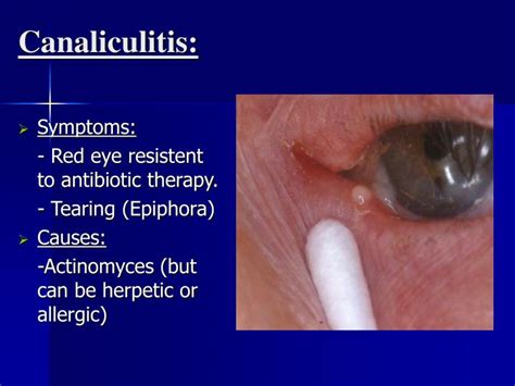 PPT - Posterior Blepharitis PowerPoint Presentation - ID:3336265