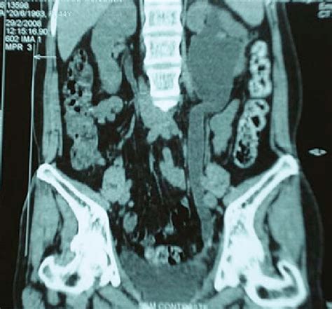 Abdominal Ct Scan Of A 44 Year Old Woman Showing A Left Distal Ureteral