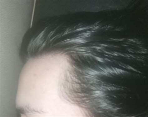 Guys Can you help me am i balding I'm so stressed right now about this😞