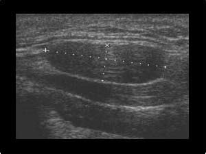 Ultrasound Benign Lymph Nodes Neck