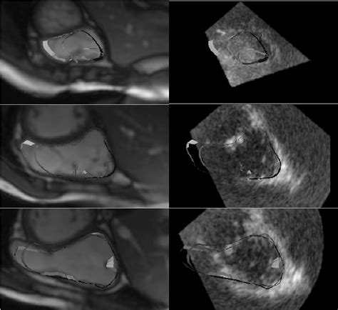 Figure 1 from Right Ventricular Assessment by Real-time Three ...