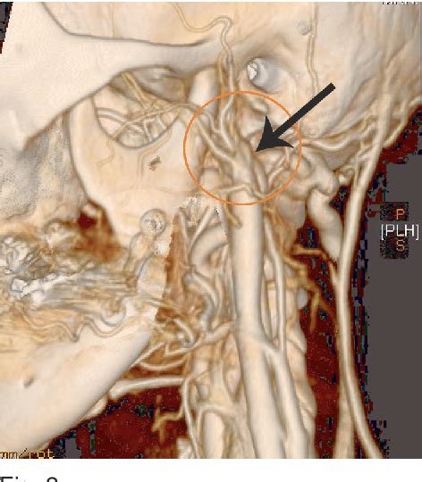 Figure 2 From Endovascular Embolization Of An External Carotid