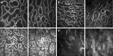 Mgd Staging Analyzed With In Vivo Confocal Microscopy Ivcm A Type