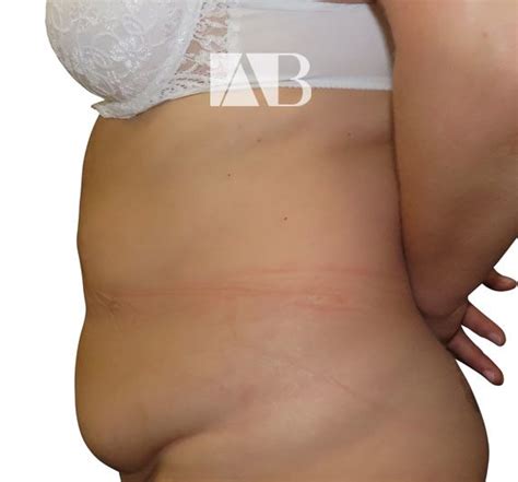 Tummy Tuck Before And After Patient 1 Left Anca Breahna Plastic