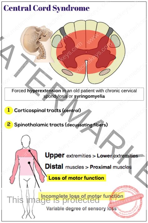 Central Cord Syndrome Medicine Keys For Mrcps