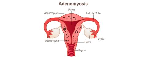 Adenomyosis Symptoms Treatment Options Eve Health