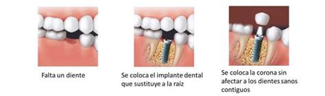 Los Mejores Implantes Dentales En Madrid Cl Nica Bernab U