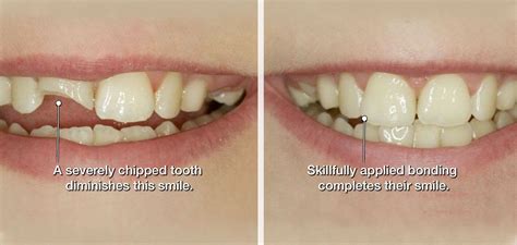 What Is Dental Bonding Steps Uses Benefits Explained