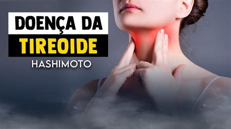 DOENÇA DA TIREOIDE Como ela afeta o corpo e o seu pescoço