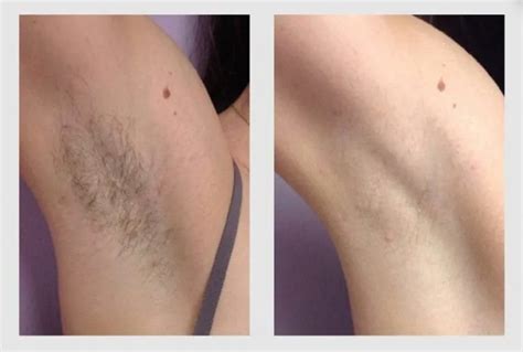 Armpit Laser Hair Removal Nyc Under Arm Laser Hair Removal Med Spa