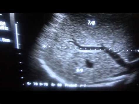 ULTRASOUND LIVER LOBES and SEGMENTS part 2 of 4 | Ultrasound ...