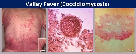 Valley Fever Benton Franklin Health District