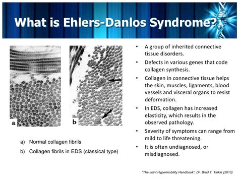 Eds Brief Overview Dysautonomia Pots Ehlers Danlos Syndrome Massage