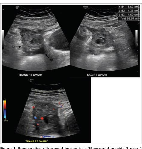 Figure 1 From Laparoscopic Management Of Ruptured Heterotopic Pregnancy