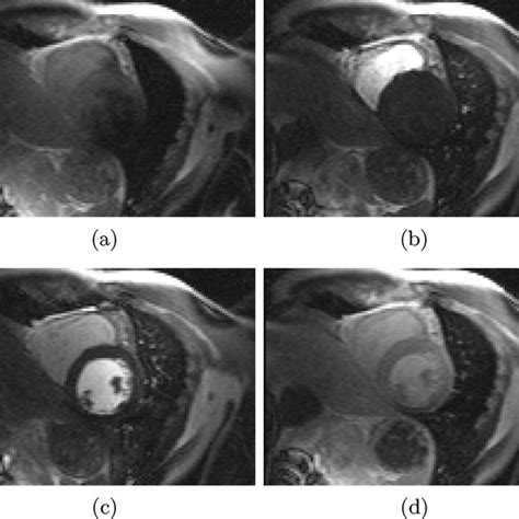 Images From A First Pass Gadolinium Enhanced Myocardial Perfusion Mri