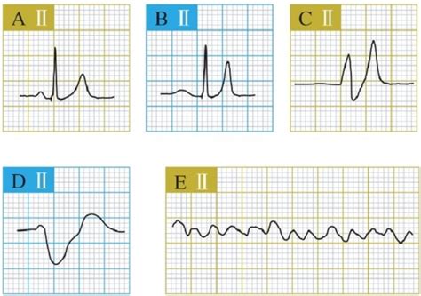 Hiperkalemia - patofisiologi, diagnosis, penatalaksanaan - Alomedika