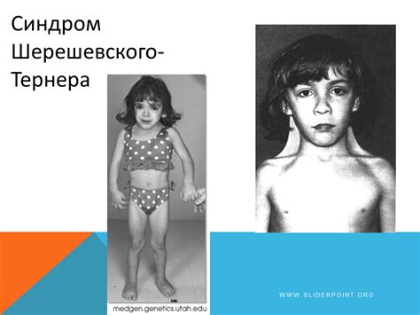 Синдром Шерешевского-Тернера