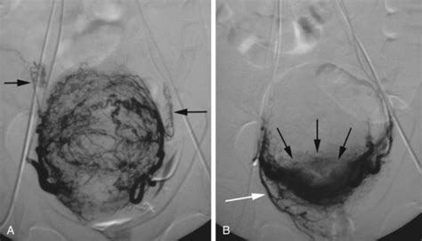 Uterine Fibroid Embolization Ufe Stanford Health Care