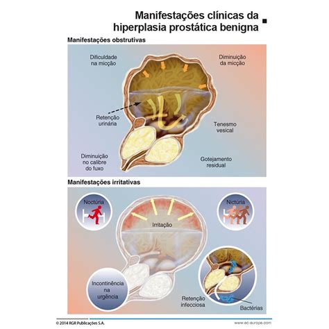 O Que Significa Hpb - Hiperplasia prostática benigna (HPB) – Laser Clin