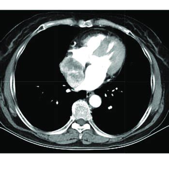 Computed Tomography Images Of Cardiac Paraganglioma A Plain Image